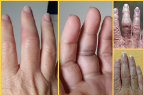 Sprained finger